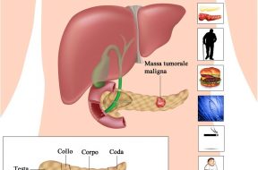 Cancro_pancreas